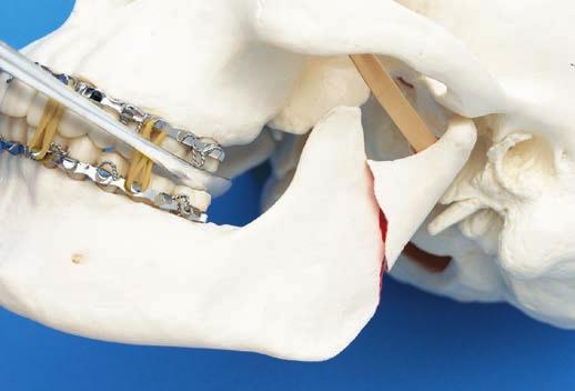 Submandibular FRACTURE REDUCTION Fracture reduction is often the most challenging part of the surgical procedure.