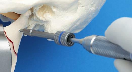 Submandibular Fracture Reduction The Manipulation Screw B 1.9 mm [386.