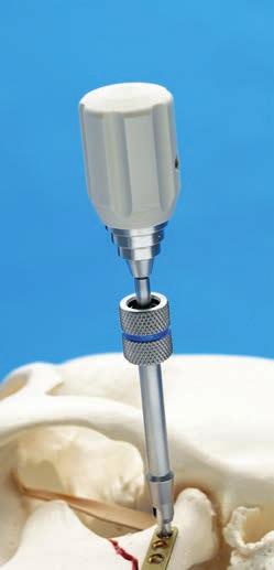 coupling [311.013]. Insert the Manipulation Screw B 1.9 mm through the cannula into the most superior plate hole, and thread into the bone.