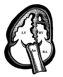Definition of fetal ToF was attempted from multiple scan planes including basic views: four-chamber view, five-chamber view, long-axis view of left and right ventricle, short view of aortic valve,