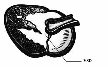 the aortic valve Fig.
