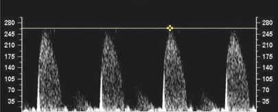 34 week of gestation, Pulsed-wave dopplerography Supplement 1. Assessment of pulmonary obstruction Short-axis view of the aortic valve.