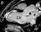 3 mm. Severe stenosis of the mid-lad was noted. Images in the long-axial oblique (B) and short-axis (C) planes show myocardial infarction (arrow) of the anterior septum extending to the apex.