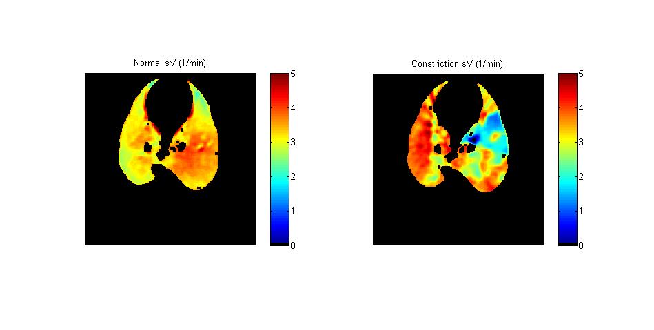 Dynamic KES-CT: regional lung ventilation Time constant (t) of Xe wash-in: C Xe =C 0 (1-e -t /t ) Specific ventilation (sv) = ventilation/v voxel : sv = 1/t Xe (mg/cm 3 ) 4 2 0 0 20 40 60