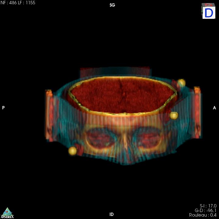 Imaging conditions Patient positioning tomography +/- post injection +/- 3D Same beam used for radiotherapy Monochromatic (80 kev ) Same flux but attenuated (14.