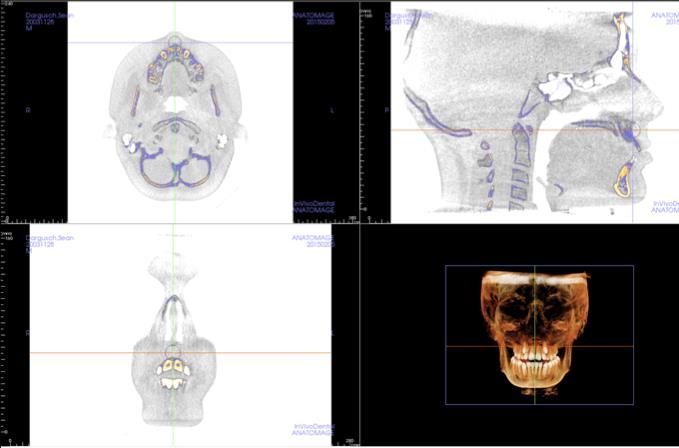 CBCT Allows us to look at the skull in all three planes.