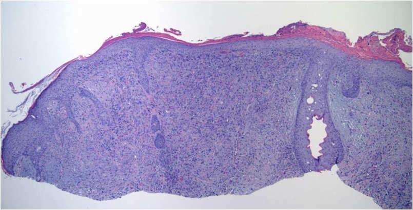 differentiated lesions and