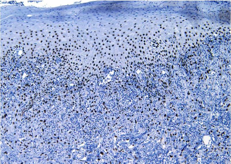 Ancillary studies Levels of small biopsies Keratin, p16, p53, p63, ki-67 stains Our panel for spindle cell lesions includes S100 Procollagen and CD10 High molecular weight keratin 903 Mimics of SCC
