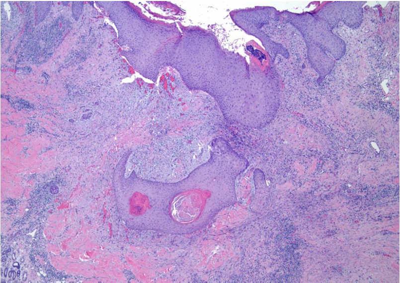 Pseudoepitheliomatous hyperplasia Result of trauma, chronic inflammation, or infection with a wide range