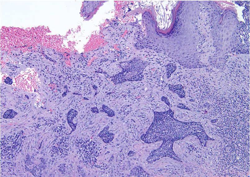 carcinoma Characterized by marked epidermal