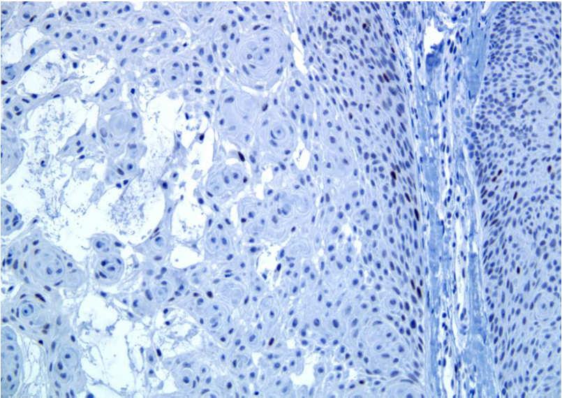 Metastatic carcinoma Renal cell