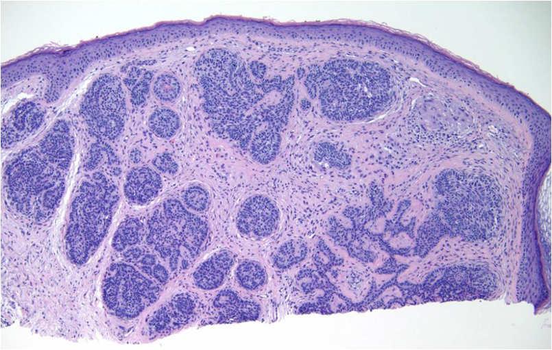 Benign basaloid proliferations Trichoepitheliomas Trichoblastomas Follicular hamartomas