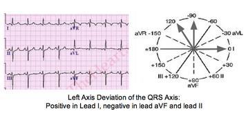 Left Axis Deviation LAD Normal