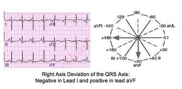 Right Axis Deviation If the QRS is predominantly negative in lead I and