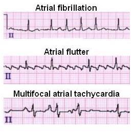 Determining Rhythm If there is a P wave before every QRS complex, and it has a sinus morphology, then normal sinus rhythm (NSR) is said to be present.