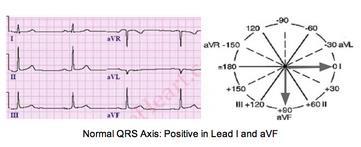 Normal QRS Axis If the QRS complex is upright