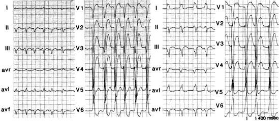 A B 98994 On admission Two days later Important questions when analysing the LBBB ECG 1.!QRS width 2.!QRS axis in the frontal plane? 3.