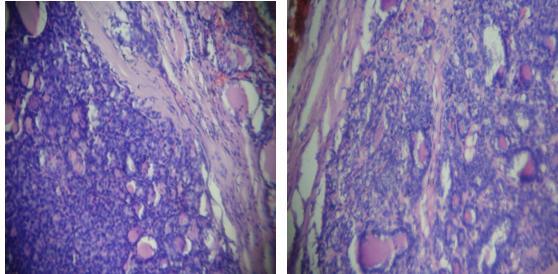 Figure - Associated Lesion - Follicular Adenoma With Encapsulated Variant Tall Cell Variant Incidence was found to be 2% in