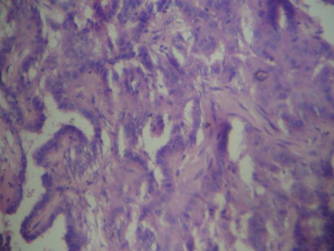 Figure: Tall Cell Variant Papillary Microcarcinoma Incidence was found to be 2% in the study group.