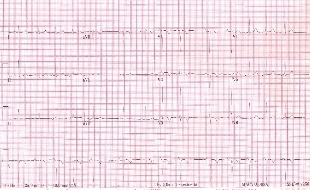 11 yrs Different P-wave axis Different