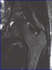 Greater Trochanter Tendon abnormalities Bursal pathology Snapping Hip