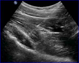 predict infection by ultrasound Negative power