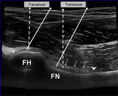 Parallel to femoral neck Consider curvilinear