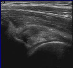 Associated with labral tear