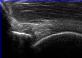 Associated with anterior labrum