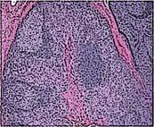 lymphoma IM-like Plasmacytic hyperplasia Florid follicular hyperplasia