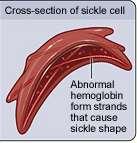 Sickle Cell Disease SNP results