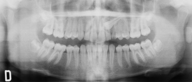 the final periodontal status of the impacted canines after surgical-orthodontic treatment to reposition the canine at the center of the alveolar ridge.