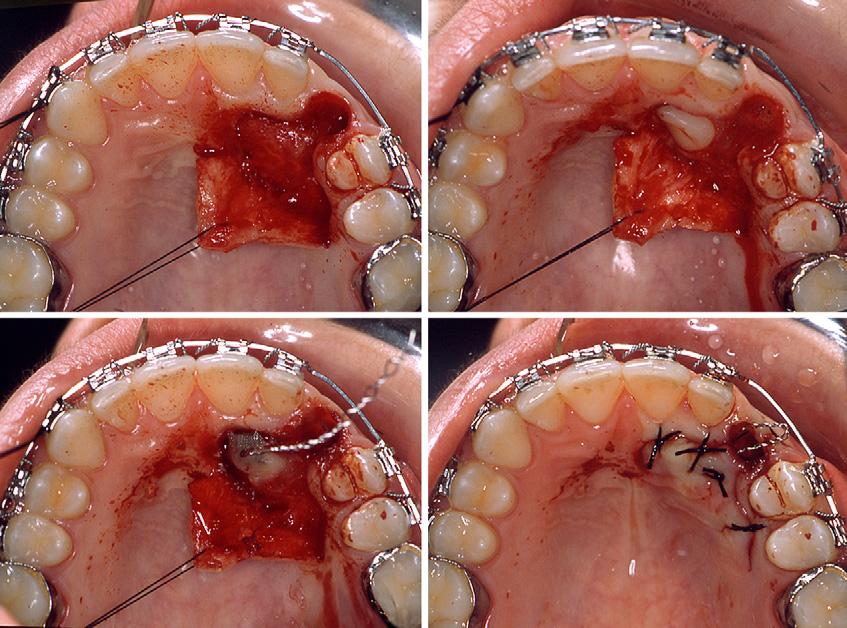 American Journal of Orthodontics and Dentofacial Orthopedics Nieri et al 757 Volume 137, Number 6 Fig 3.