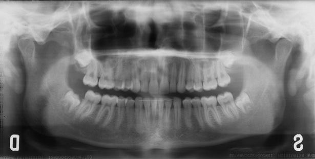 The panoramic radiograph shows correct position of the impacted maxillary left canine in the dental arch. applied to guide the impacted canine directly toward the center of the alveolar ridge.