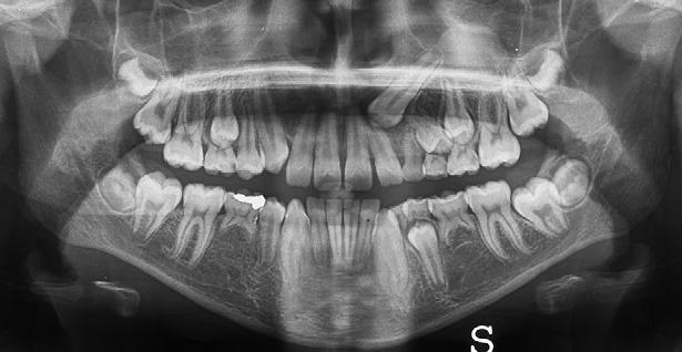 Final orthodontic treatment aligned the canine in the maxillary arch. Two patients are shown in Figures 1 to 10.