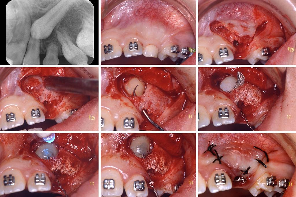 American Journal of Orthodontics and Dentofacial Orthopedics Nieri et al 759 Volume 137, Number 6 Fig 8. After extraction of the deciduous canine, a buccal full-thickness flap is elevated.