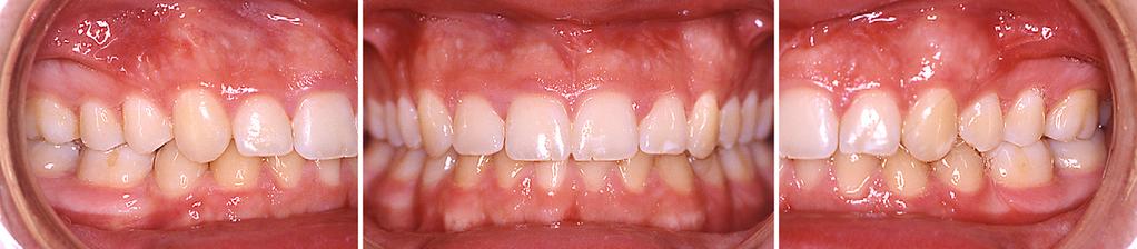 The maxillary left canine is properly aligned in the arch with healthy periodontal tissues. of traction was 8.0 6 2.3 months, and duration of treatment was 22.0 6 4.8 months.