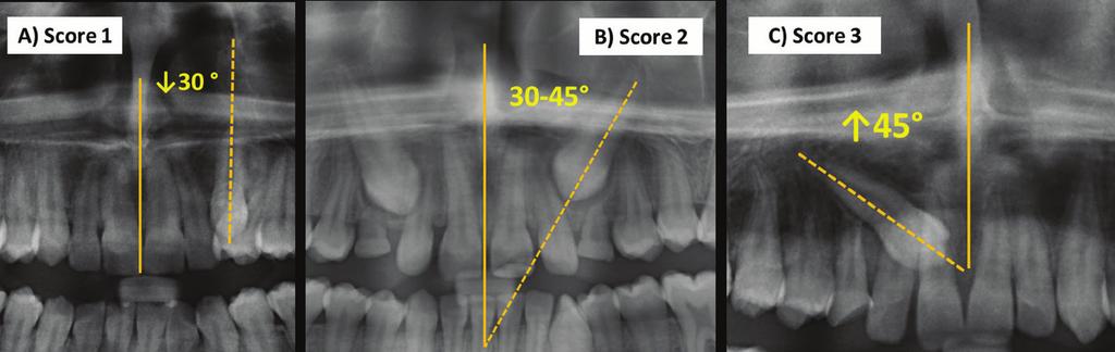 junction and the middle of the adjacent incisors), moderate (between the middle and the apices of the adjacent incisors) and severe (above the apices of the adjacent incisors)].