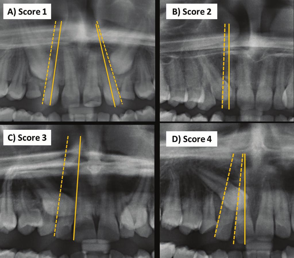 Fig. 3: Horizontal position of the impacted canine A) Score 1: canine overlapping up to half the width of the lateral incisor, B) Score 2: canine overlapping over to half the width of the lateral