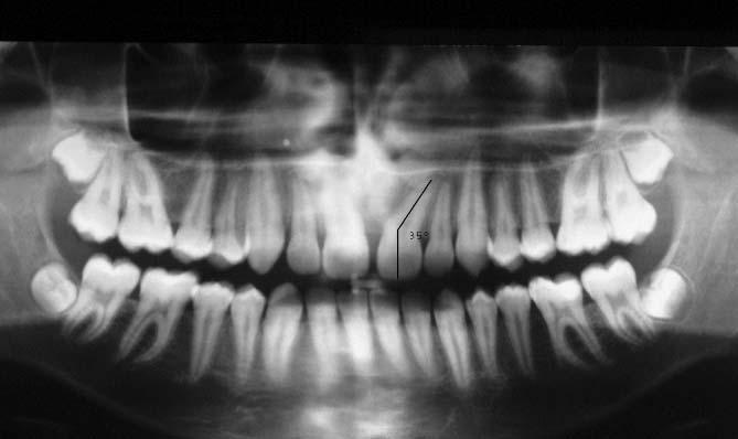 In fact the gingival flap was sutured back in such a way that the bracketed crown was not exposed into the oral cavity.
