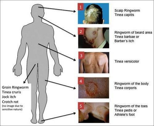 Slide 16 : 1)scalp airway tinea capitis 2)ringworm of beard area tinea barbrae or barber's itch.