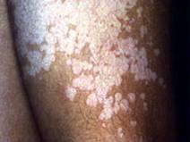 Dermatomycoses(the most common of which are Candida spp.