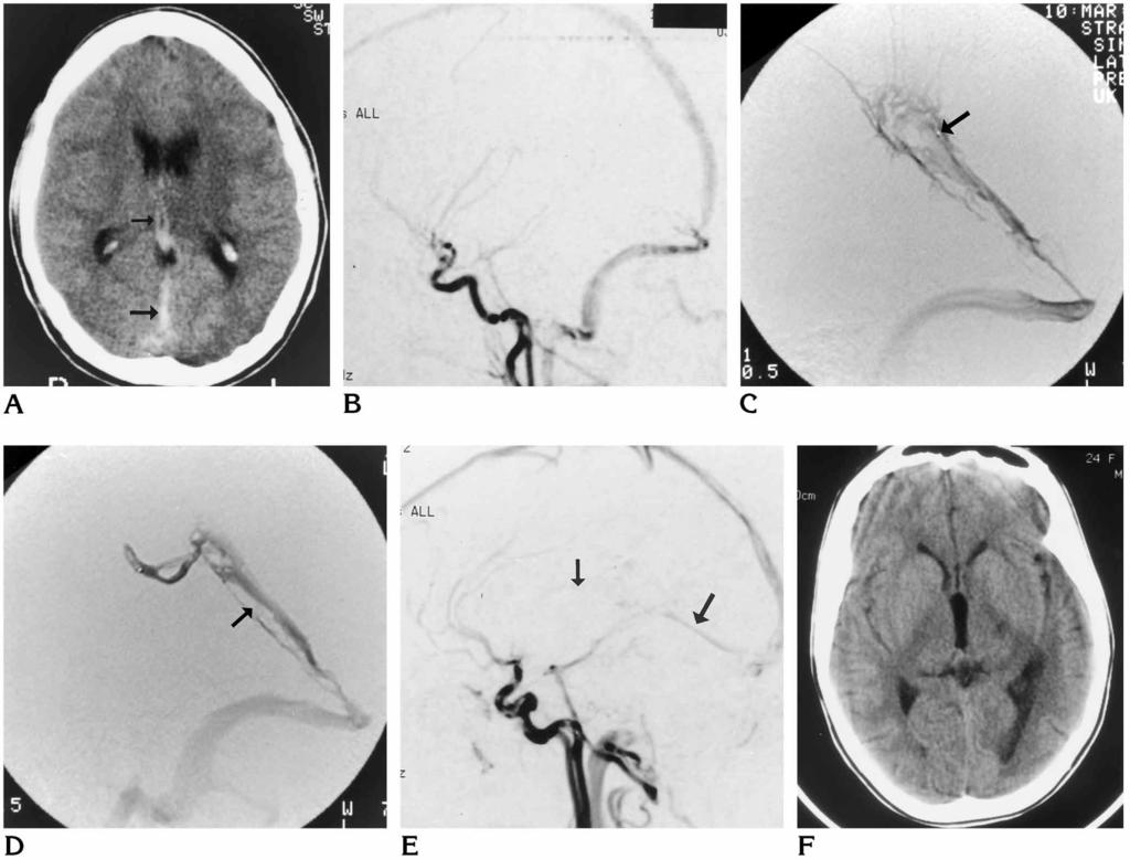 AJNR: 18, March 1997 THROMBOLYSIS 503 Fig 1. Case 2: 24-year-old woman with headache and confusion.