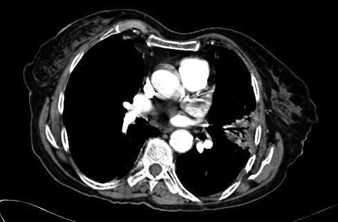 A contrast-enhanced staging CT of the thorax demonstrated consolidation in the anterior segment of the left upper lobe and small volume mediastinal adenopathy (figures 2 and 3).