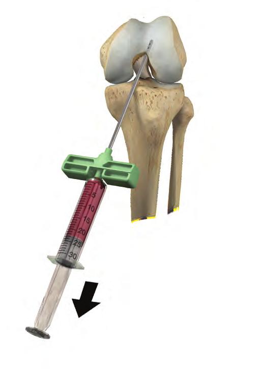 Fully insert the aspiration needle into the medullary canal of the femur.