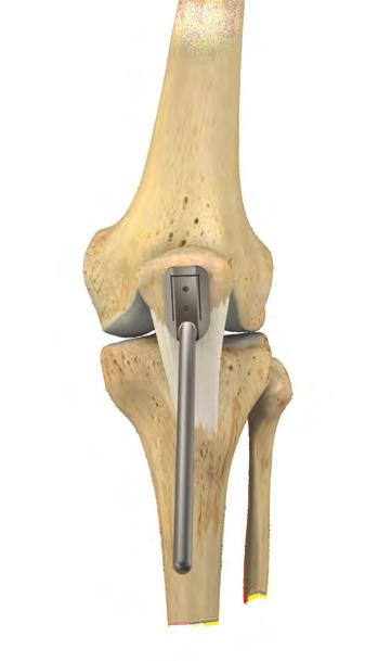 Biologically-Assisted ACL Reconstruction Figure 1 Figure 2 Bone-Tendon-Bone Harvest If desired for
