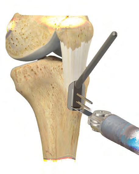 A bone marrow aspiration technique is provided in Appendix A.