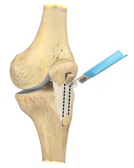 patella with two guide pins (Figure 3).