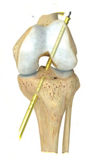 tip of the guide. Remove the tibial guide.