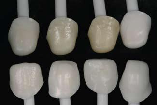 Figure 4: Eight zirconia copings were fabricated and displayed for